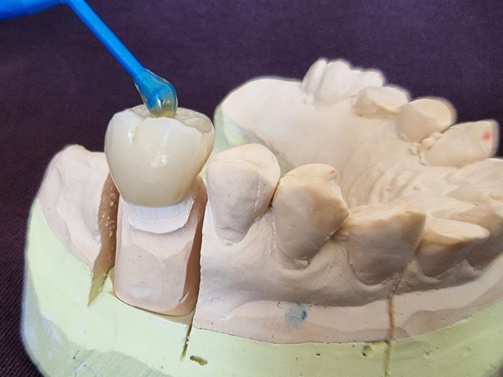 Hochwertige Zahnkronen und Zahnbrücken - Moderne Zahnmedizin in Wien