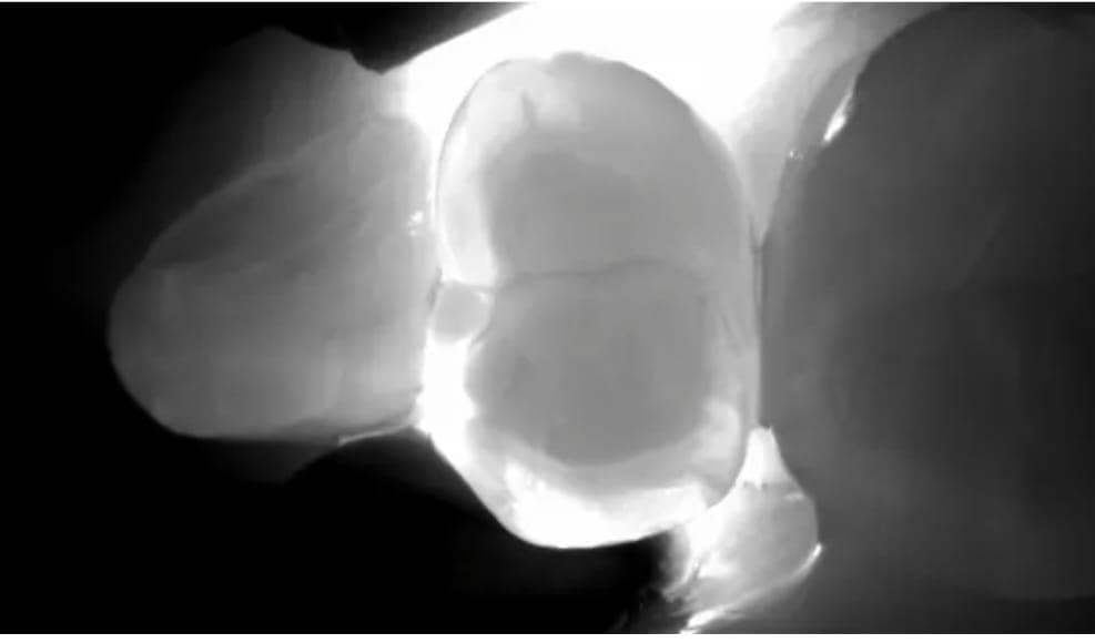 Diagnocam-Aufnahme – Transillumination zeigt Karies frühzeitig sichtbar
