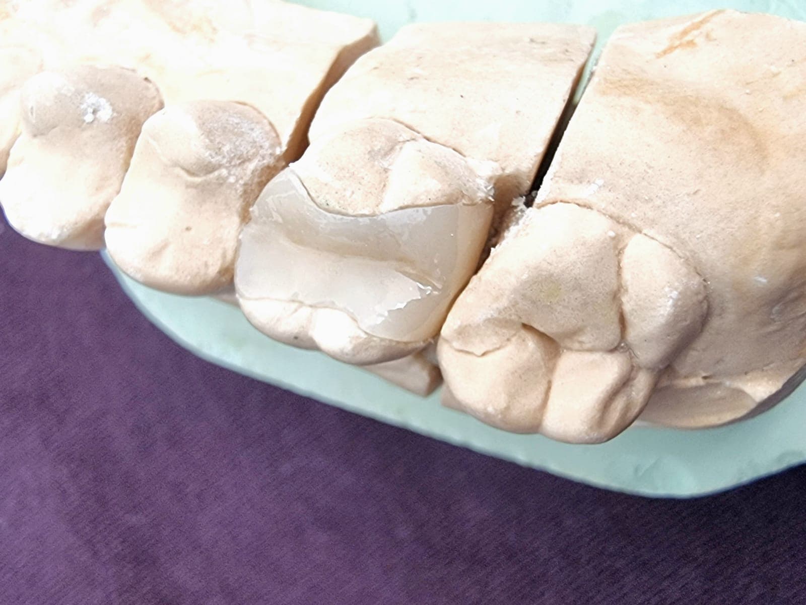 Keramikinlays - Hochwertige Einlagefüllungen